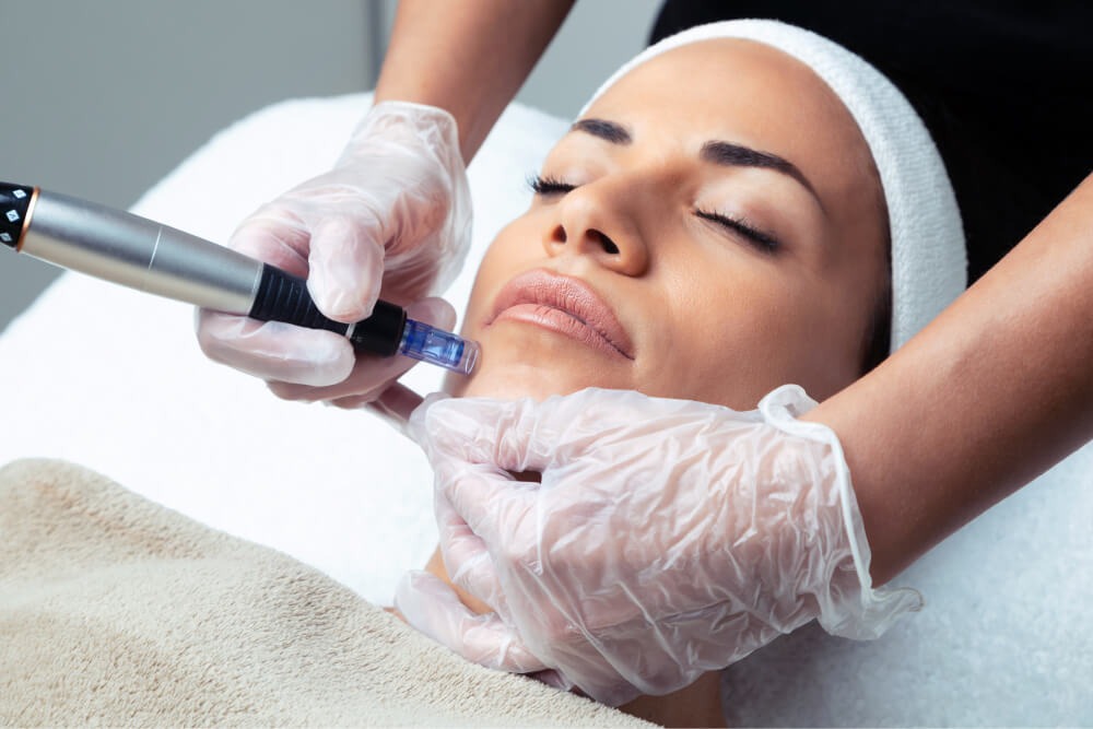 Microneedling: The Secret To Youthful Skin